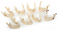 Виды переломов нижней челюсти (комплект из 8 моделей) Н05 – портал поставщиков НСППО